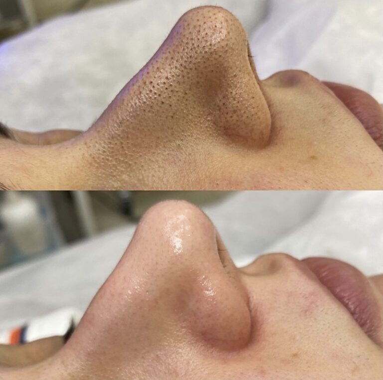 Salicylate Clean Cotton Sheet Pore Exfoliating