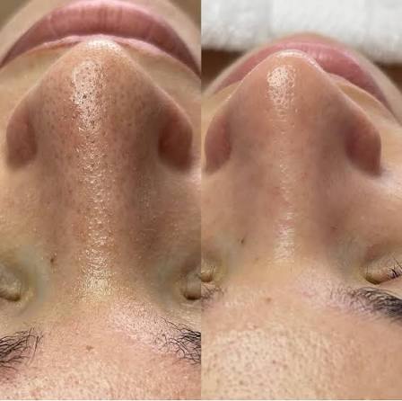 Salicylate Clean Cotton Sheet Pore Exfoliating